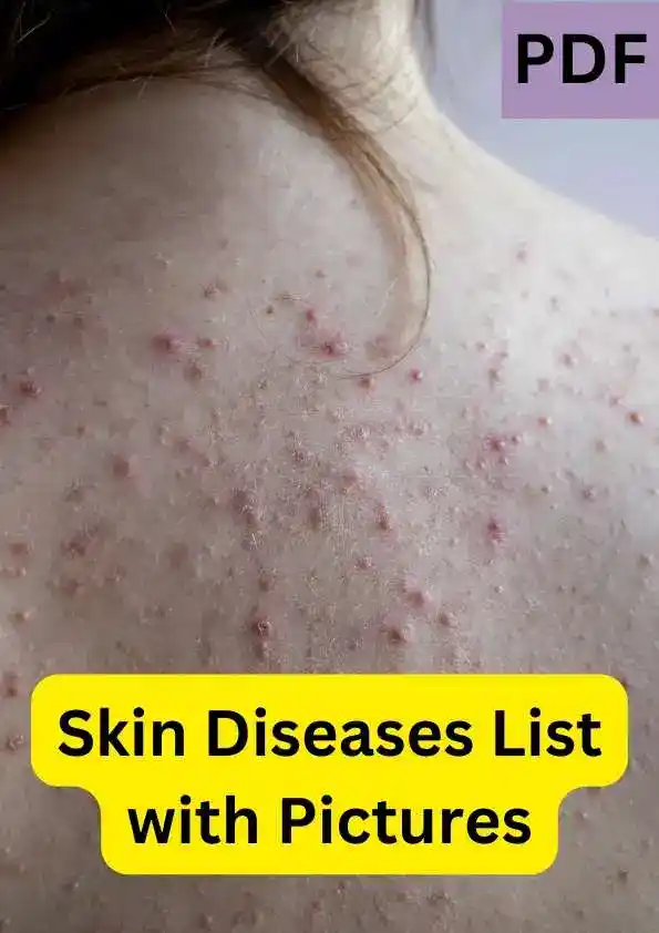 Skin Diseases List with Pictures